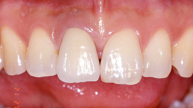 前歯 の 形 種類