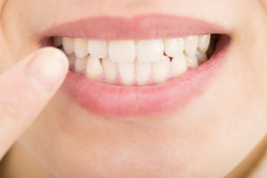 審美歯科治療とホワイトニング